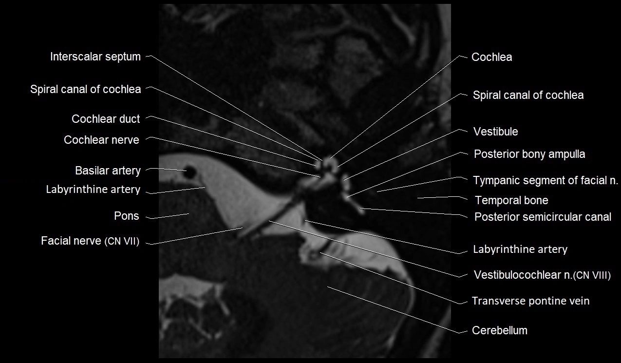 Internal auditory canal (IAC) axial cross sectional anatomy image 9.webp